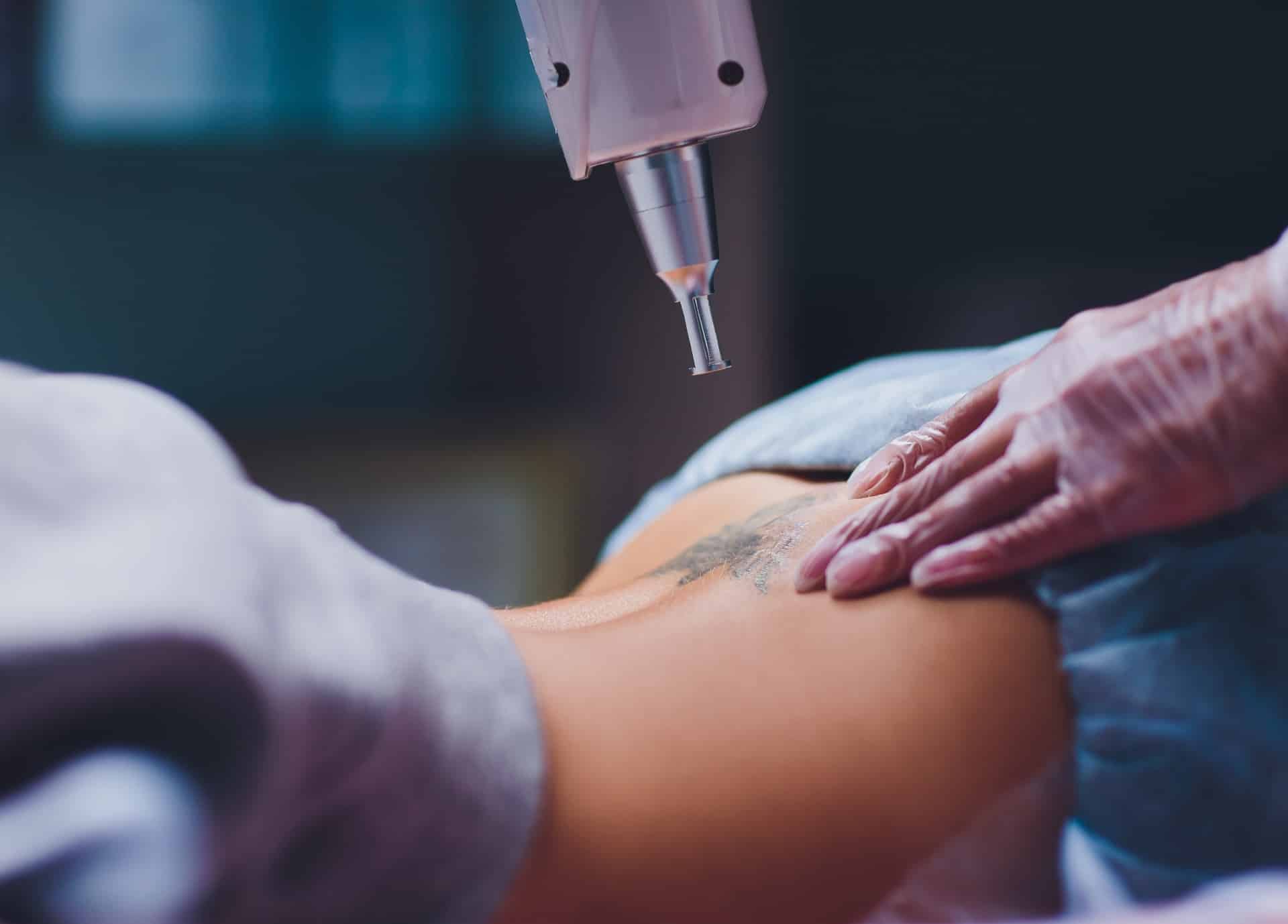 Je veux enlever un tatouage : causes et traitements pour se faire détatouer | Dr Taveau | Paris